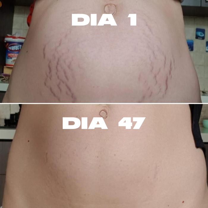 LUVARE™ – Crema Reafirmante Anti-Estrías