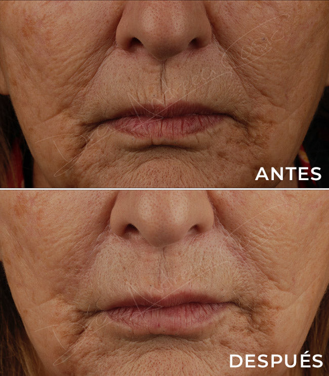 LUVARE™ Retinal Shot